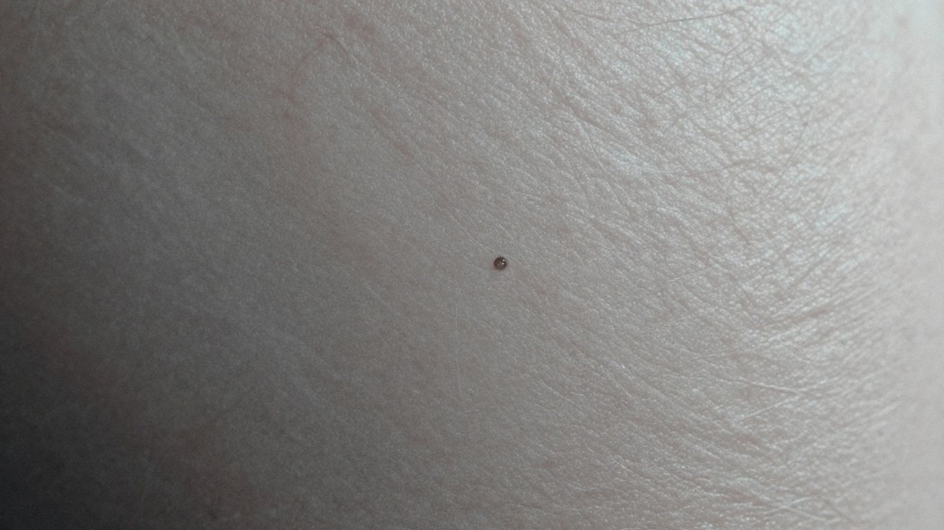 Argyria skin discoloration illustration