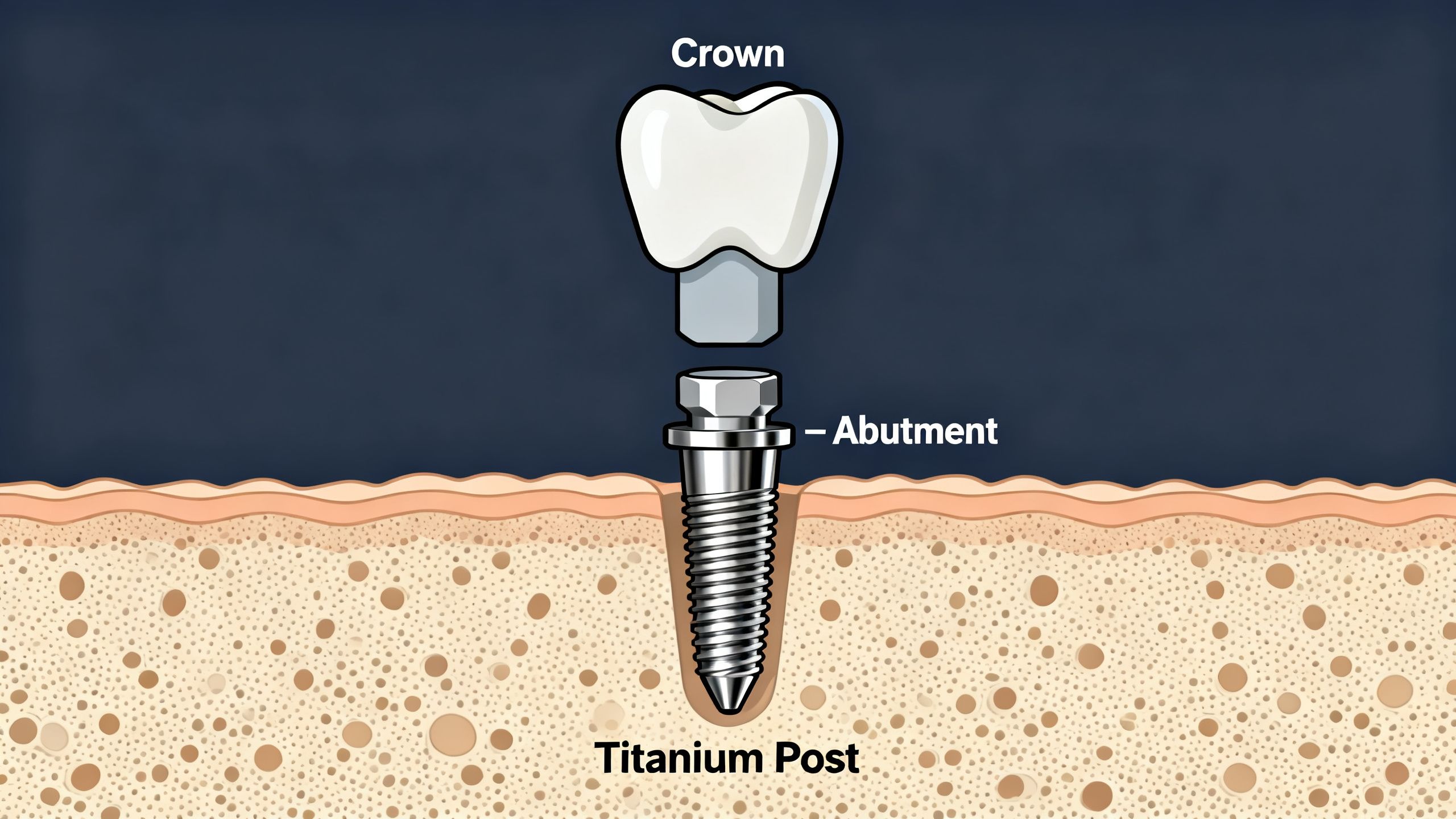 A diagram showing the three components of a dental implant: the titanium post, the abutment, and the crown.