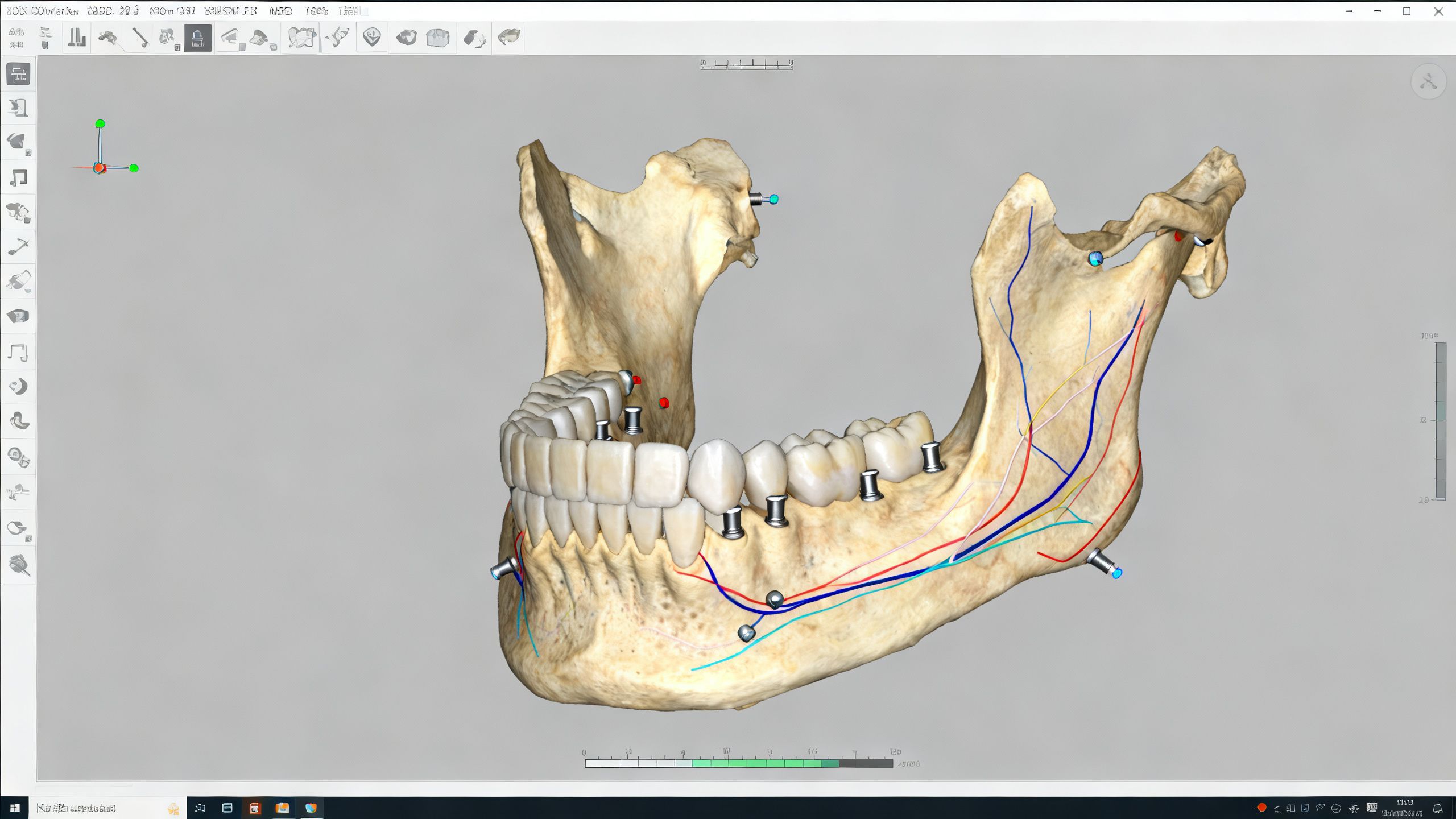 A detailed 3D scan of a patient's jaw on a computer screen, used for planning dental implant placement.