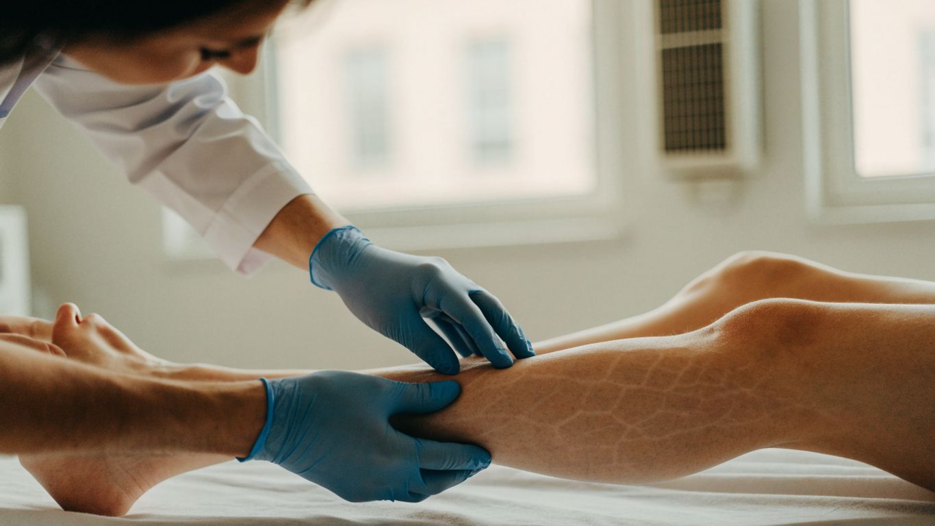 Avaliação vascular e tratamento de vasinhos