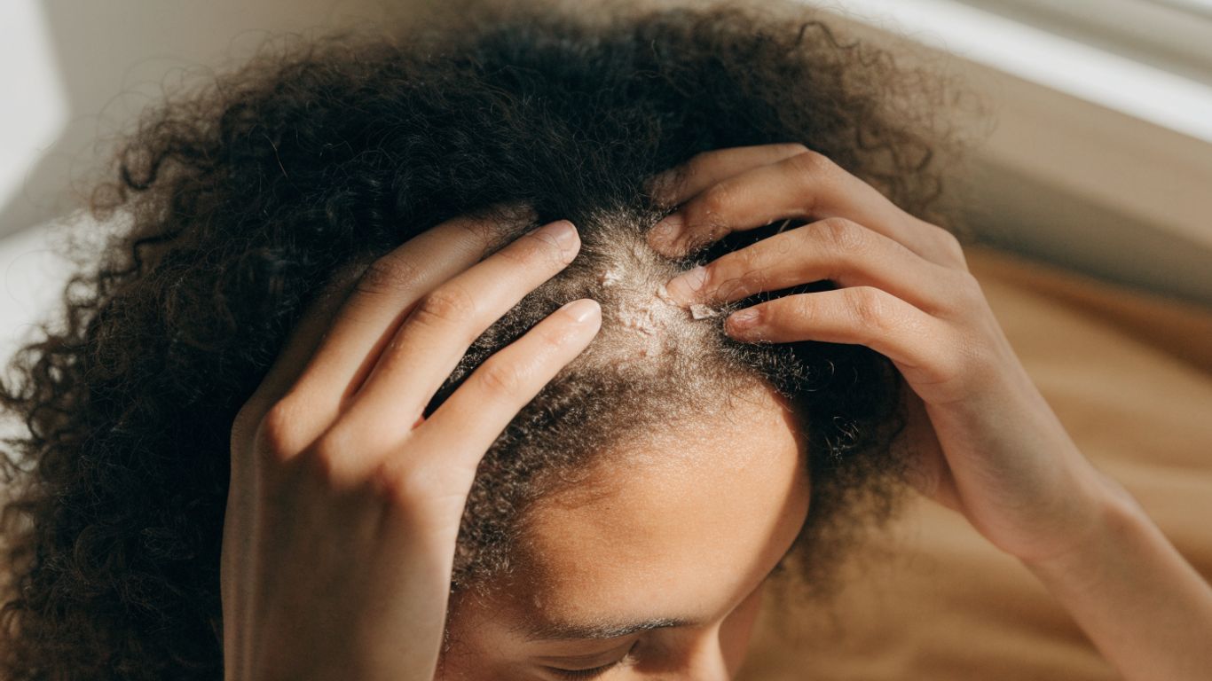 Curly hair parted to reveal scalp flakes