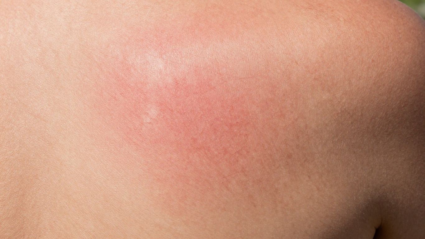 Sonnengeschädigte Haut mit Rötungen und Schuppenbildung.