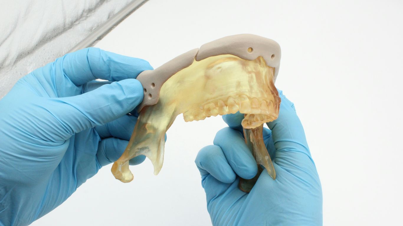 Hands in blue gloves holding a dental model.