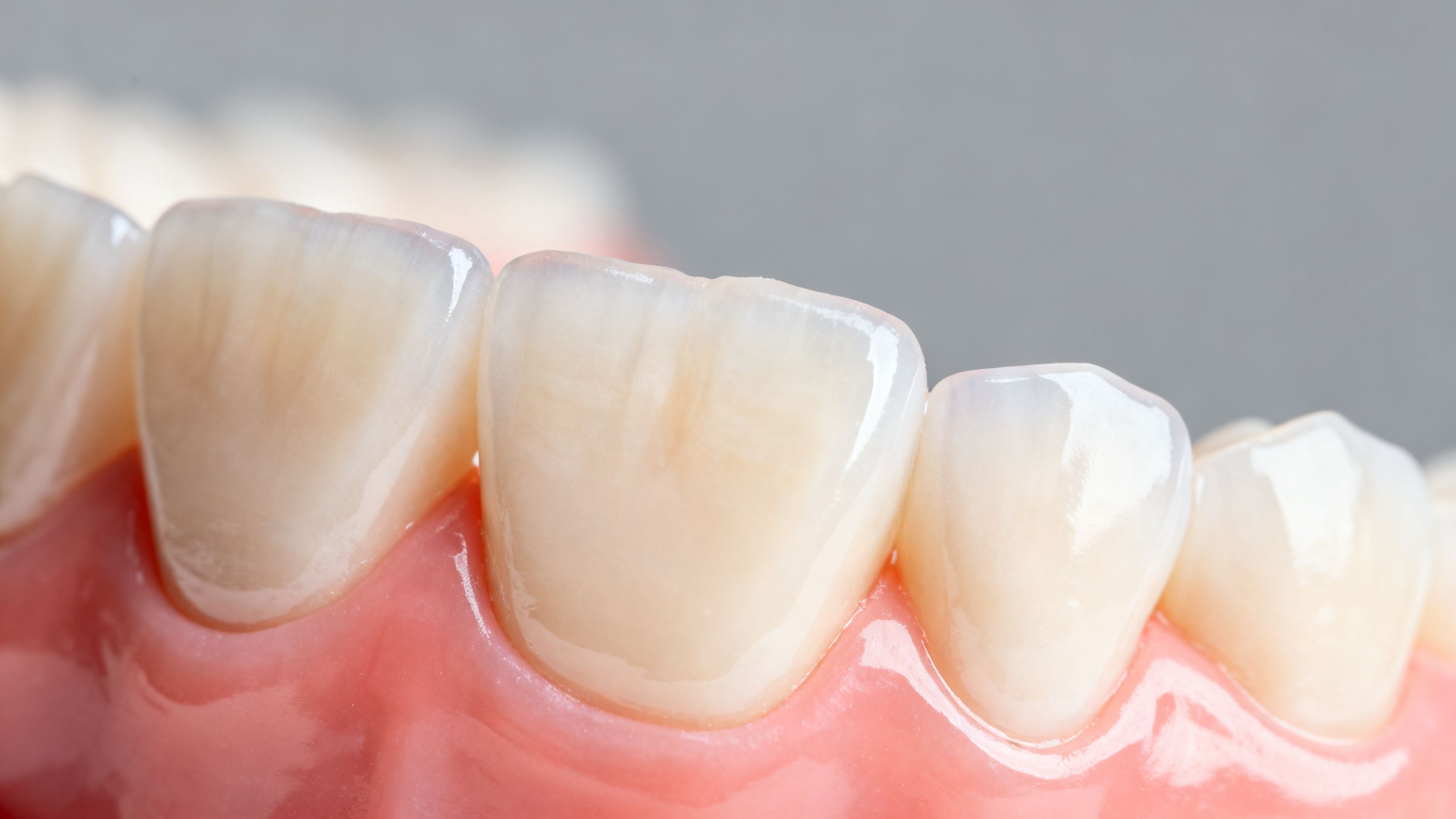 A close-up, clinical-style photo of a set of perfectly crafted porcelain veneers on a dental model, showcasing their translucency and natural appearance.