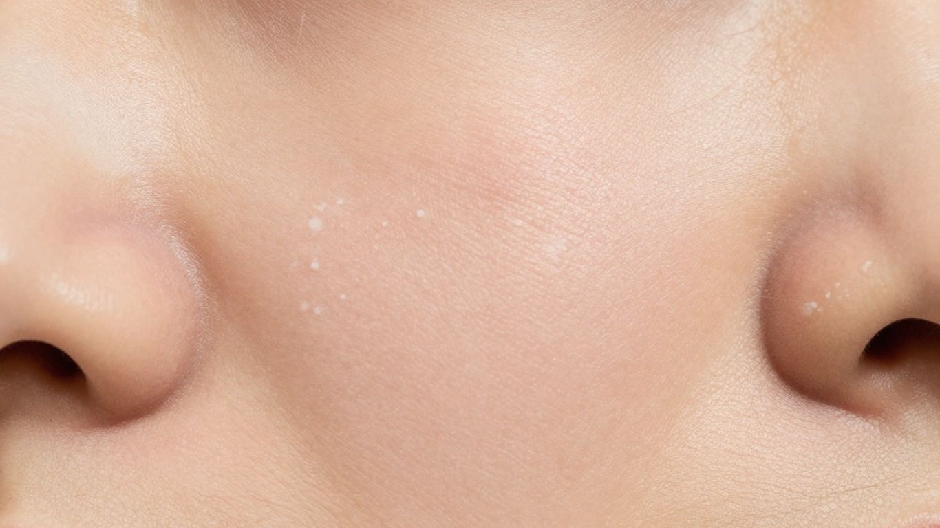 Weiße Flecken auf Haut