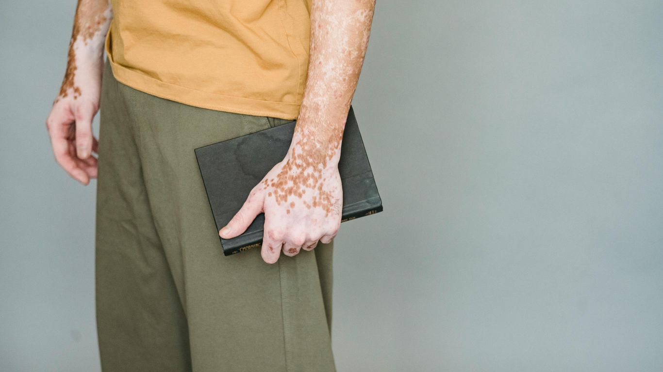 A person holds a book with skin that has vitiligo.