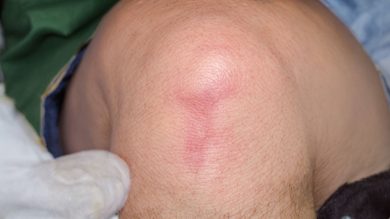 Rodilla con cicatriz de cirugía de reemplazo.