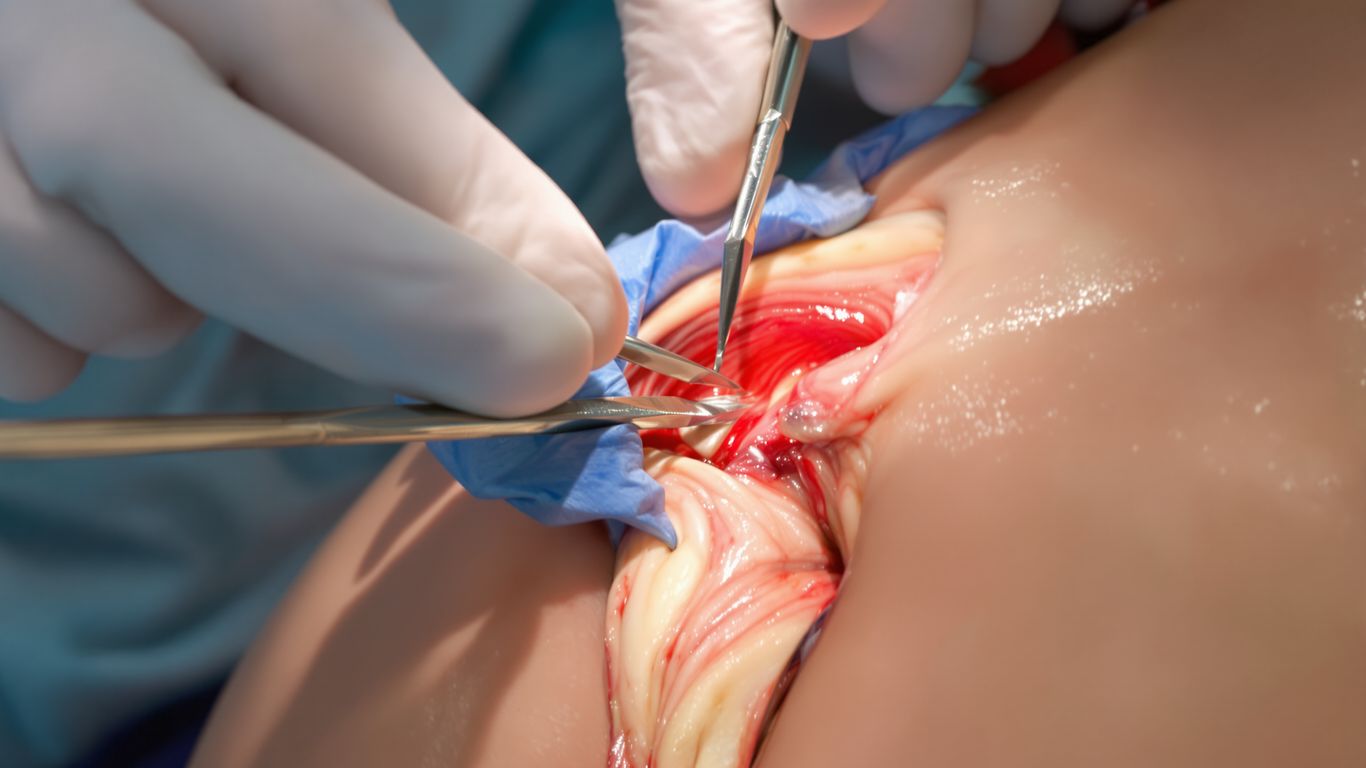 Manos cirujano reparando manguito rotador.