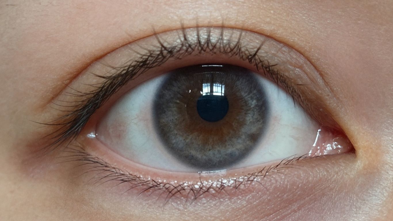 Close-up of an eye with a grey spot on the sclera.