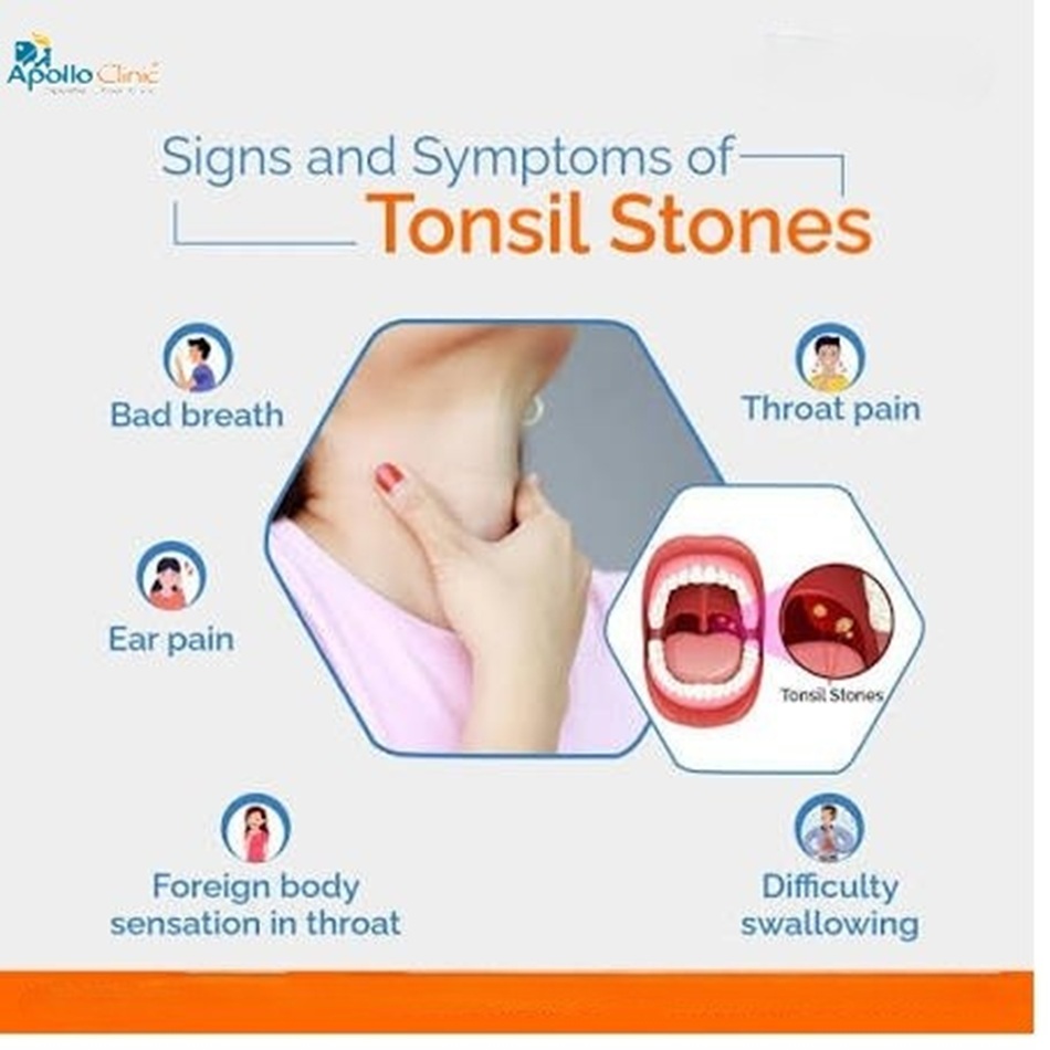 Tonsil Stones : Symptoms