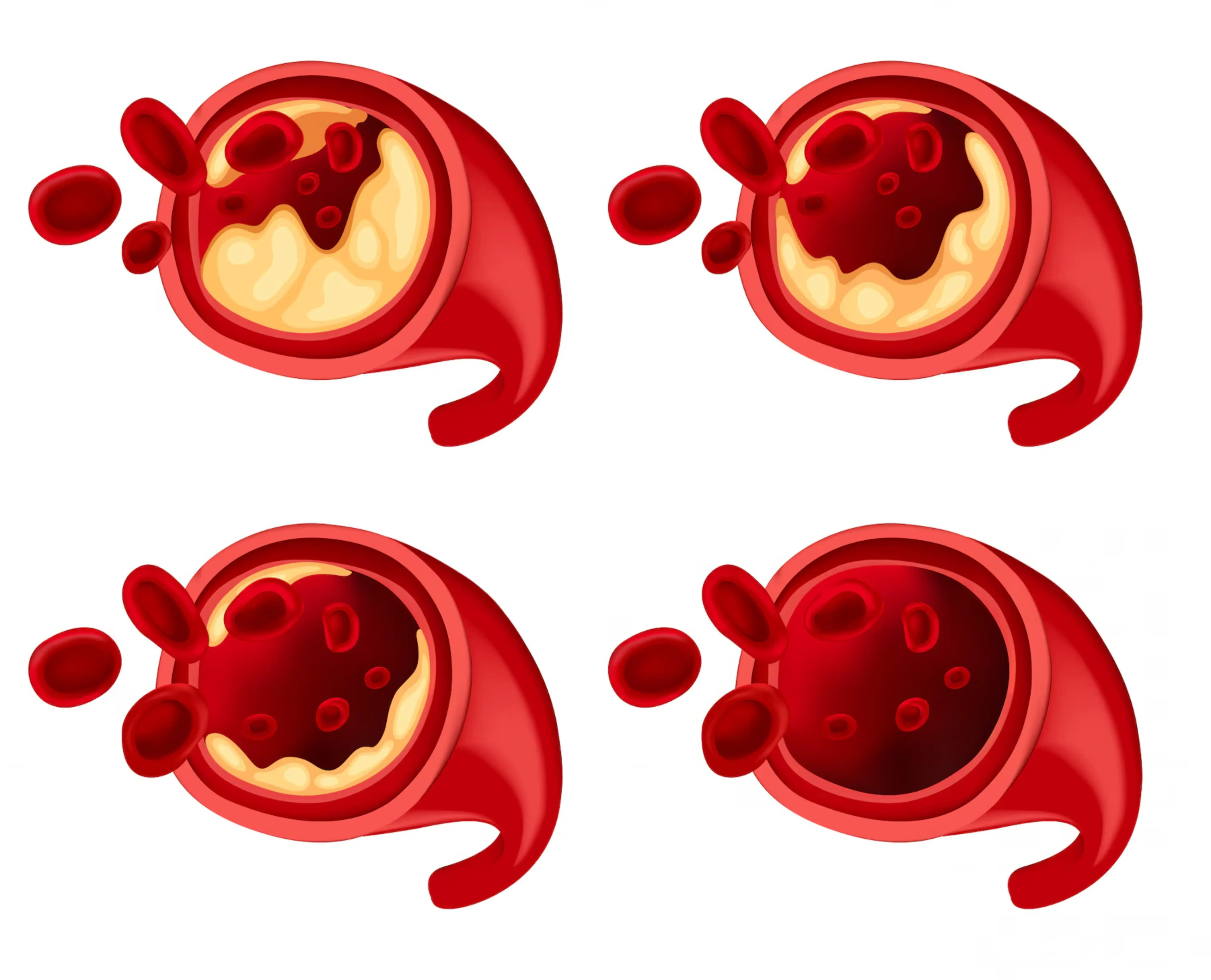 Ilustración de células sanguíneas con colesterol en diferentes etapas.