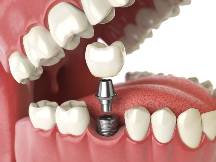 Dental implant in gum with natural teeth, Belgian clinic.